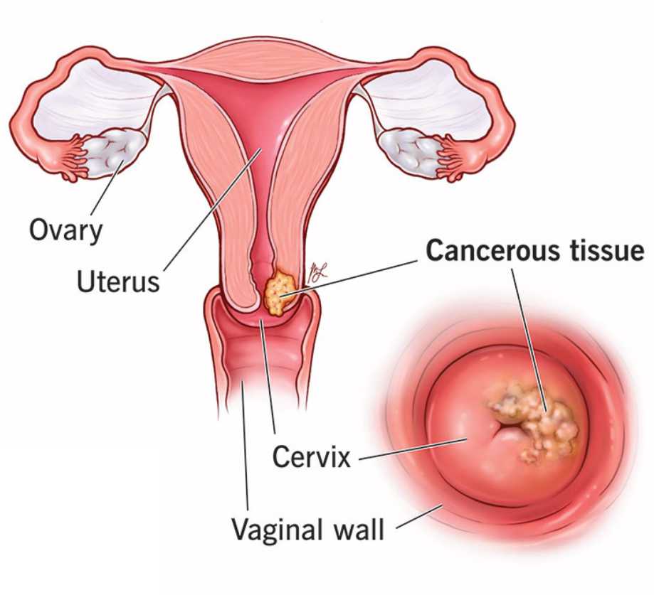 Cervix 