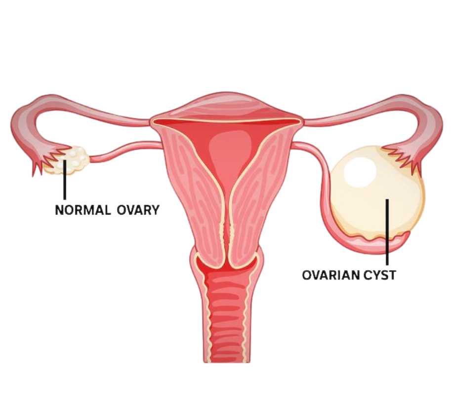 Ovarian Cysts