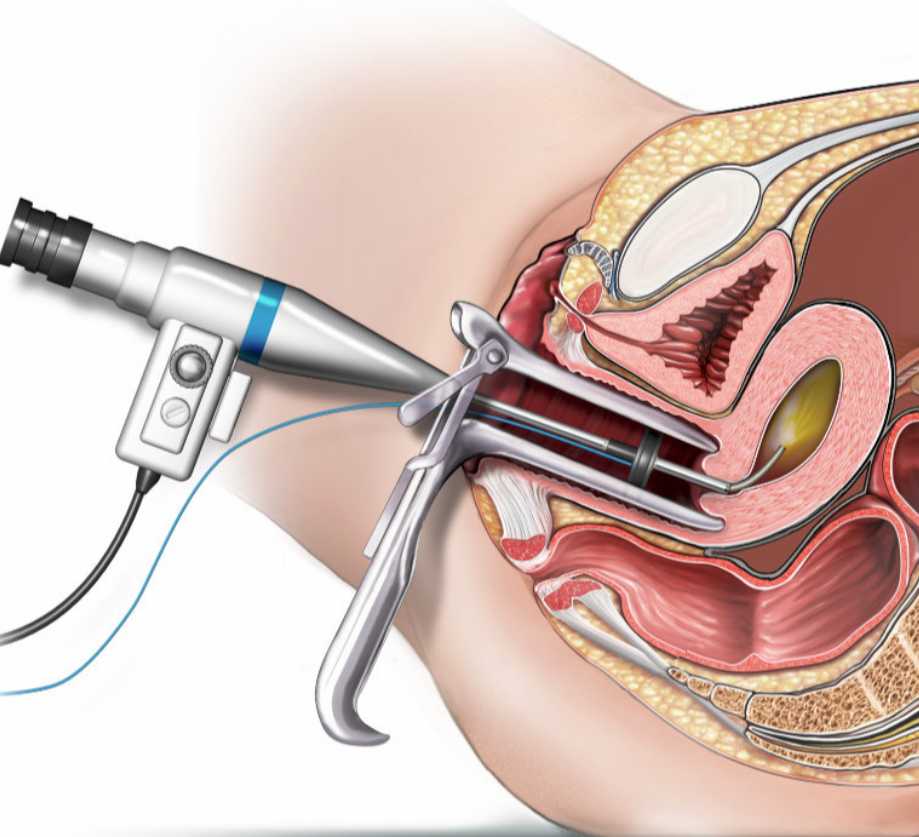 Laparoscopy