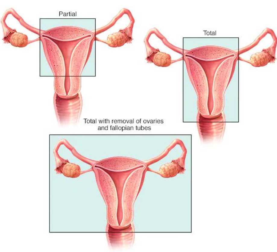 Hysterectomy