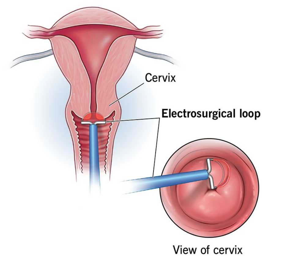 Loop Excision Procedures